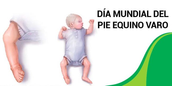 DÍA-MUNDIAL-DEL-PIE-EQUINO-VARO